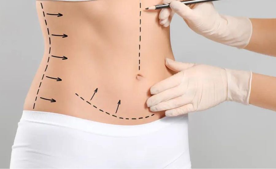 Tummy Tuck