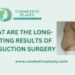 Liposuction surgery