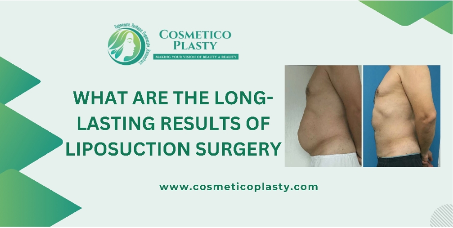 Liposuction surgery