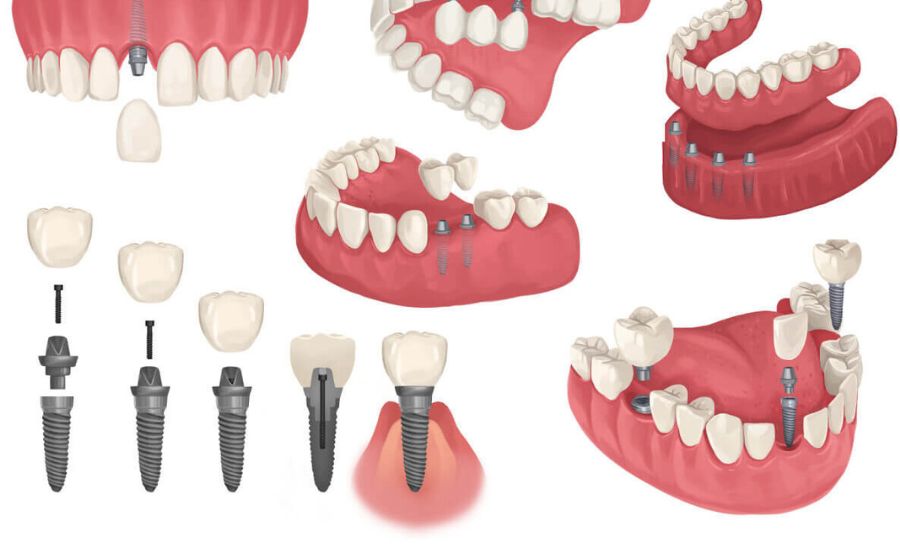 Dental Implants