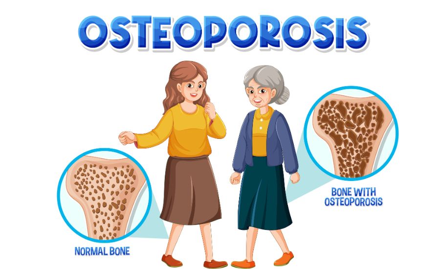 Osteoporosis