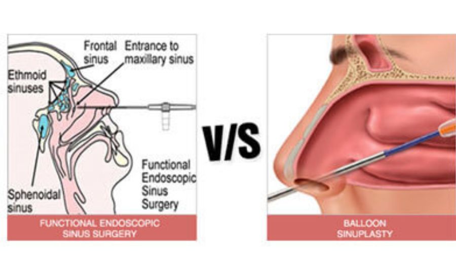 Balloon Sinuplasty