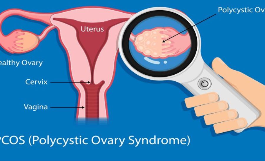 Gynecological