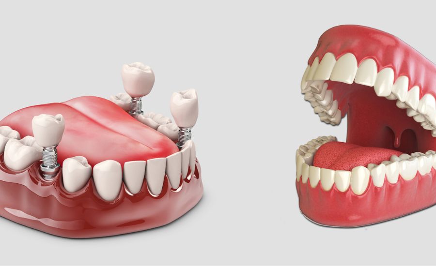 Dental Implants